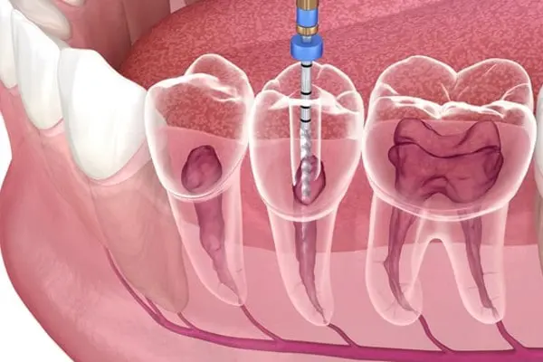 root canal treatment