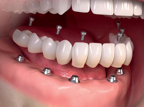 How Dental Implant Can Help Fix Single Missing Teeth?