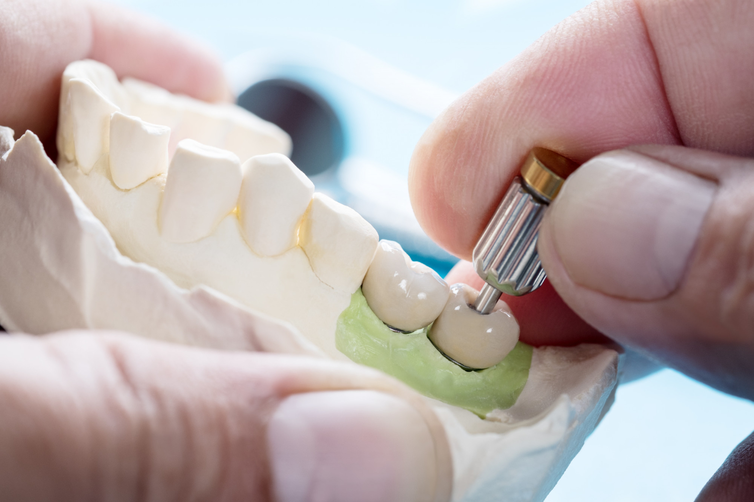 What Are Types Of Dental Crowns